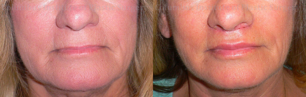 Lip Lift before and after photo by Columbus Institute of Plastic Surgery in Columbus, OH