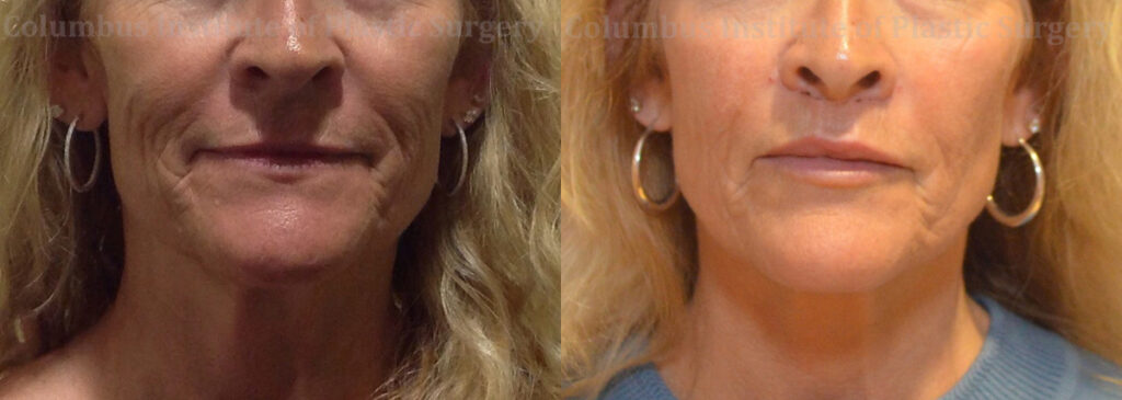 Lip Lift before and after photo by Columbus Institute of Plastic Surgery in Columbus, OH