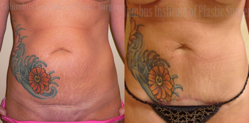Mini Abdominoplasty (Mini Tummy Tuck) before and after photo by Columbus Institute of Plastic Surgery in Columbus, OH