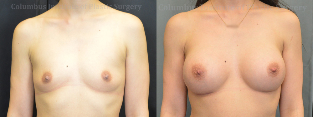 Breast Augmentation – 300cc-400cc before and after photo by Columbus Institute of Plastic Surgery in Columbus, OH