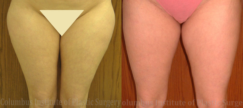 Liposuction before and after photo by Columbus Institute of Plastic Surgery in Columbus, OH