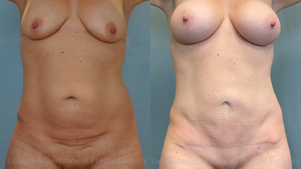 Mini Abdominoplasty (Mini Tummy Tuck) before and after photo by Columbus Institute of Plastic Surgery in Columbus, OH