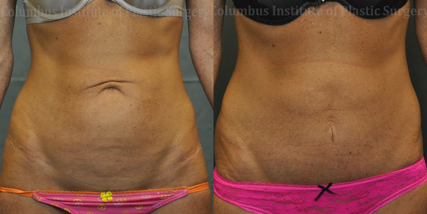 Mini Abdominoplasty (Mini Tummy Tuck) before and after photo by Columbus Institute of Plastic Surgery in Columbus, OH