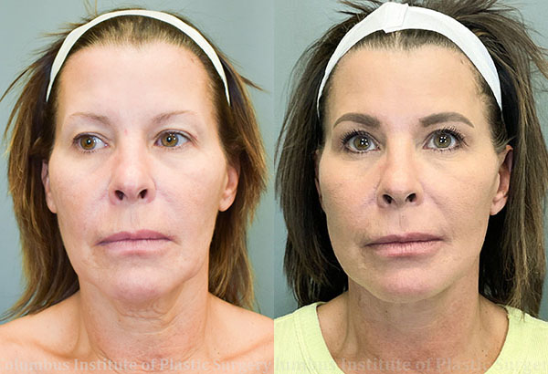 Mini Facelift before and after photo by Columbus Institute of Plastic Surgery in Columbus, OH