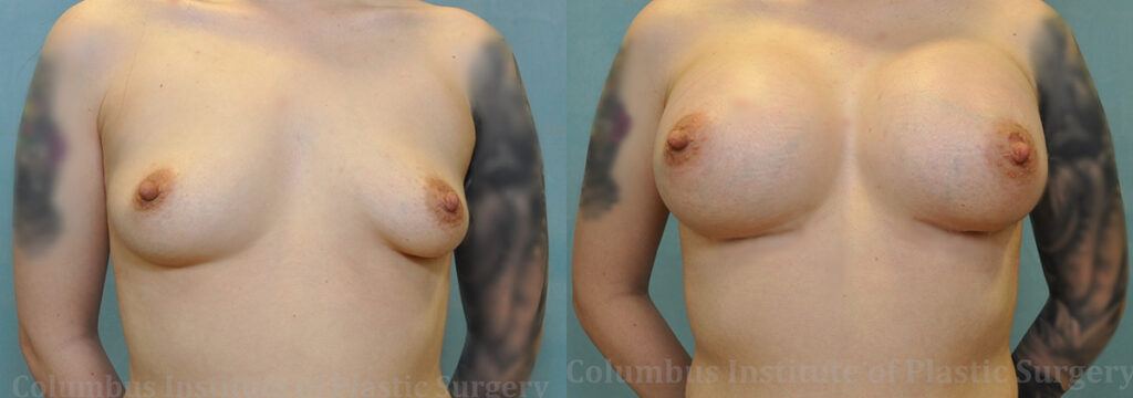 Breast Augmentation before and after photo by Columbus Institute of Plastic Surgery in Columbus, OH