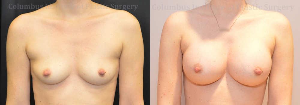 Breast Augmentation – 300cc-400cc before and after photo by Columbus Institute of Plastic Surgery in Columbus, OH