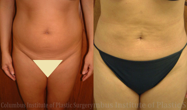 Liposuction before and after photo by Columbus Institute of Plastic Surgery in Columbus, OH