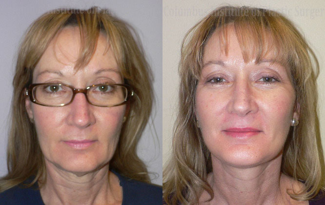Mini Facelift before and after photo by Columbus Institute of Plastic Surgery in Columbus, OH