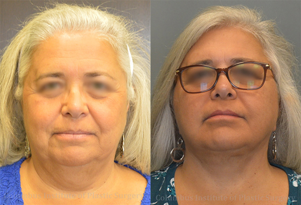 Mini Facelift before and after photo by Columbus Institute of Plastic Surgery in Columbus, OH