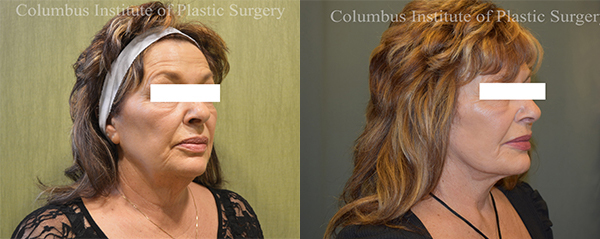 Mini Facelift before and after photo by Columbus Institute of Plastic Surgery in Columbus, OH