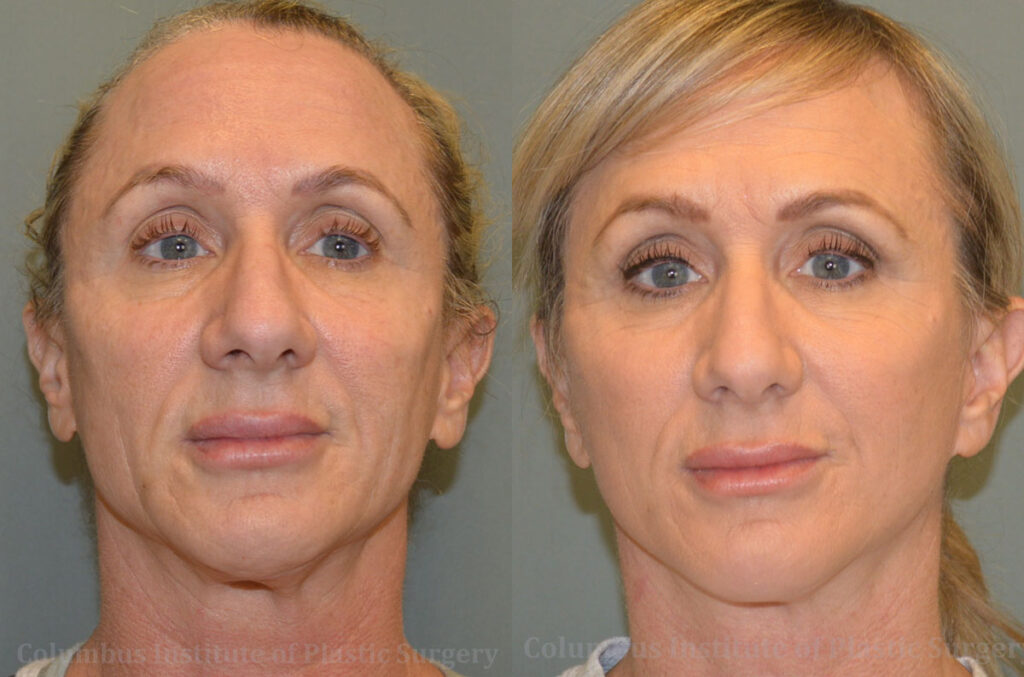 Mini Facelift before and after photo by Columbus Institute of Plastic Surgery in Columbus, OH