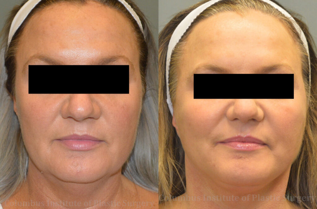 Mini Facelift before and after photo by Columbus Institute of Plastic Surgery in Columbus, OH