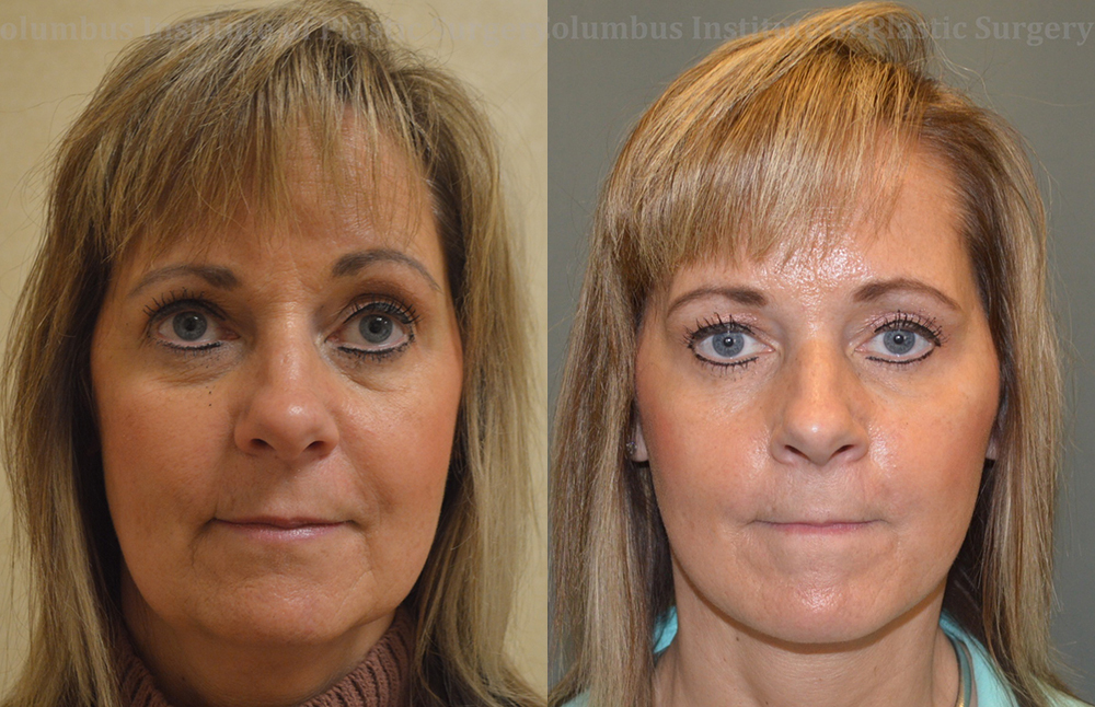 Mini Facelift before and after photo by Columbus Institute of Plastic Surgery in Columbus, OH