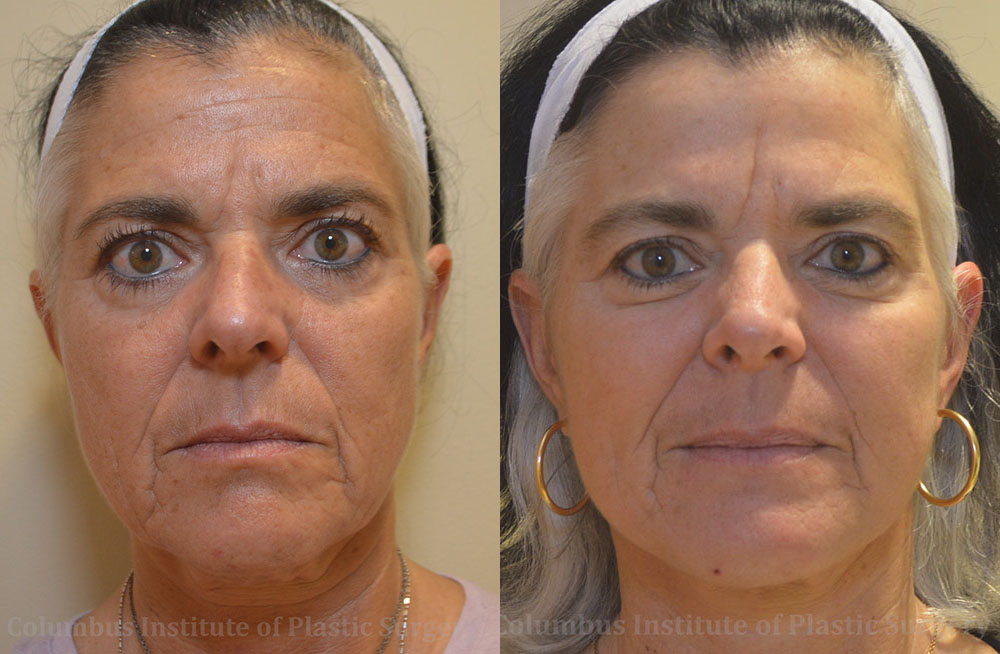 Mini Facelift before and after photo by Columbus Institute of Plastic Surgery in Columbus, OH