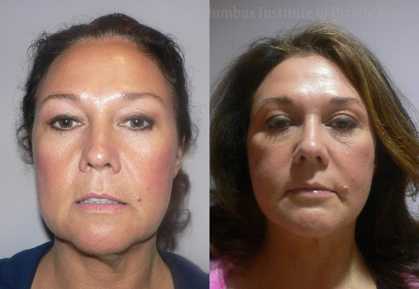 Mini Facelift before and after photo by Columbus Institute of Plastic Surgery in Columbus, OH