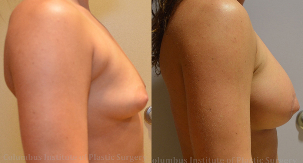 Mini Mastopexy and Augmentation (Breast Lift with Implants) before and after photo by Columbus Institute of Plastic Surgery in Columbus, OH Mini Mastopexy and Augmentation (Breast Lift with Implants) before and after photo by Columbus Institute of Plastic Surgery in Columbus, OH