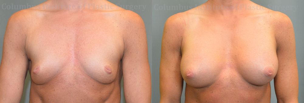 Breast Augmentation – 300cc-400cc before and after photo by Columbus Institute of Plastic Surgery in Columbus, OH