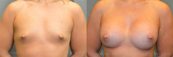 Breast Augmentation – 400cc-500cc before and after photo by Columbus Institute of Plastic Surgery in Columbus, OH