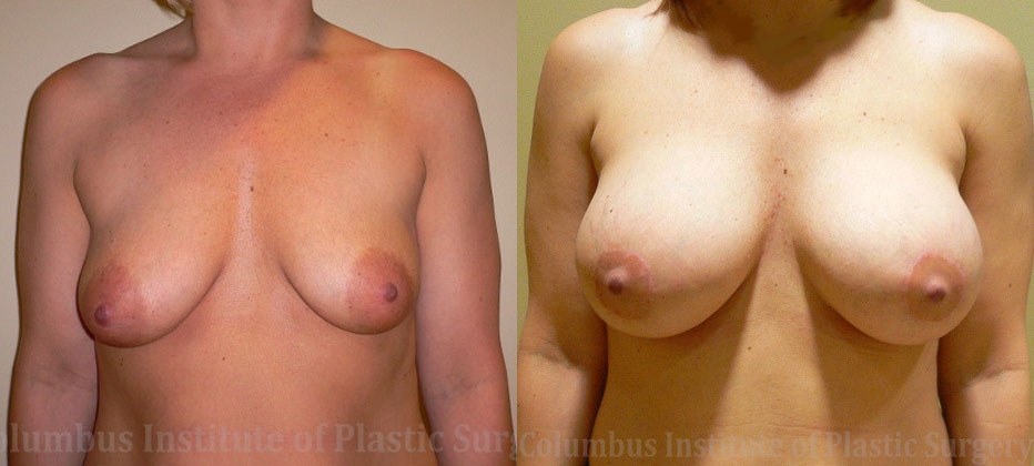 Mini Mastopexy and Augmentation (Breast Lift with Implants) before and after photo by Columbus Institute of Plastic Surgery in Columbus, OH