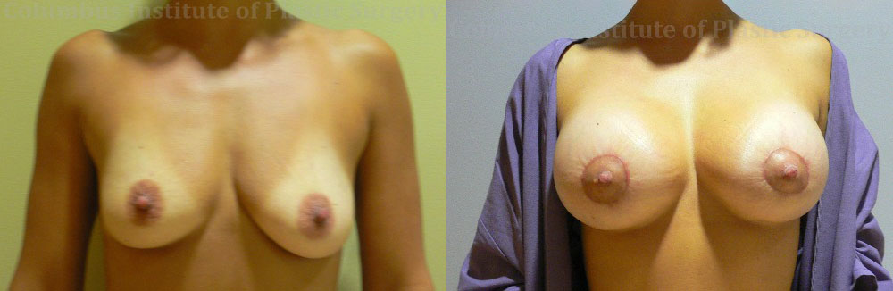 Mini Mastopexy and Augmentation (Breast Lift with Implants) before and after photo by Columbus Institute of Plastic Surgery in Columbus, OH