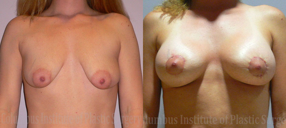 Mini Mastopexy and Augmentation (Breast Lift with Implants) before and after photo by Columbus Institute of Plastic Surgery in Columbus, OH
