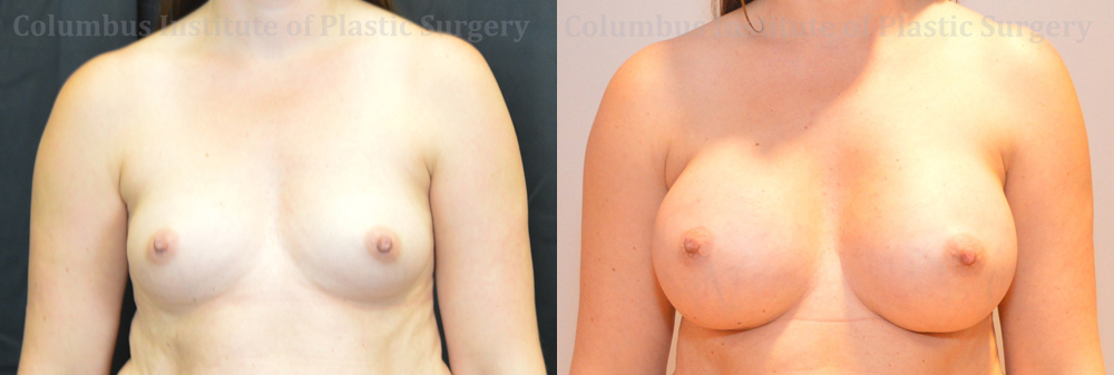 Breast Augmentation – 300cc-400cc before and after photo by Columbus Institute of Plastic Surgery in Columbus, OH
