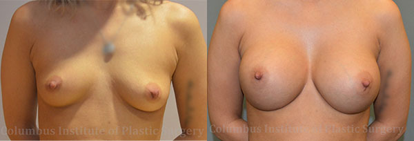Breast Augmentation – 400cc-500cc before and after photo by Columbus Institute of Plastic Surgery in Columbus, OH