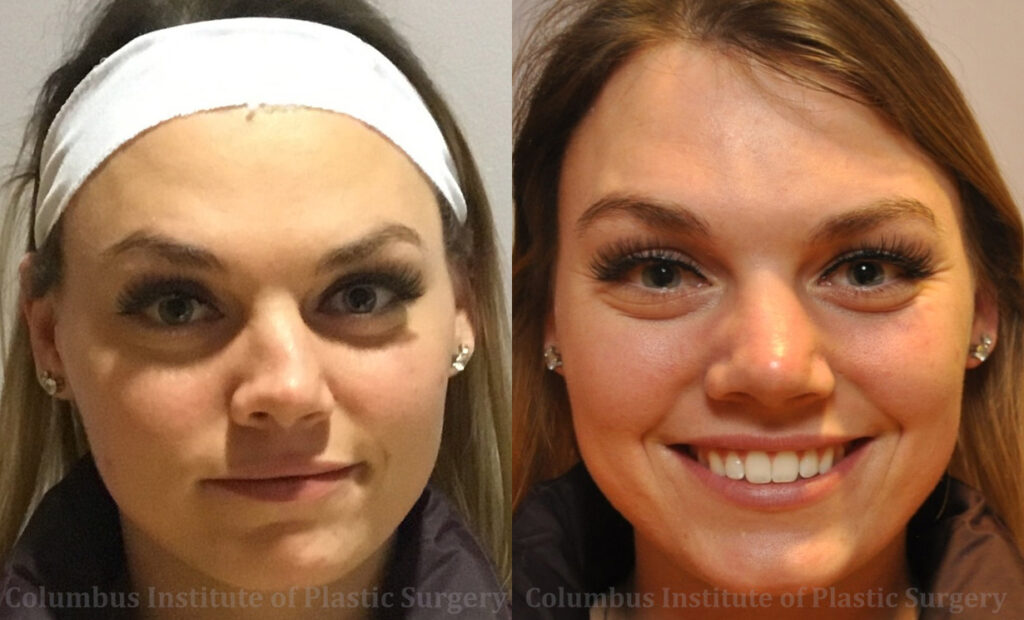 Nonsurgical Rhinoplasty before and after photo by Columbus Institute of Plastic Surgery in Columbus, OH