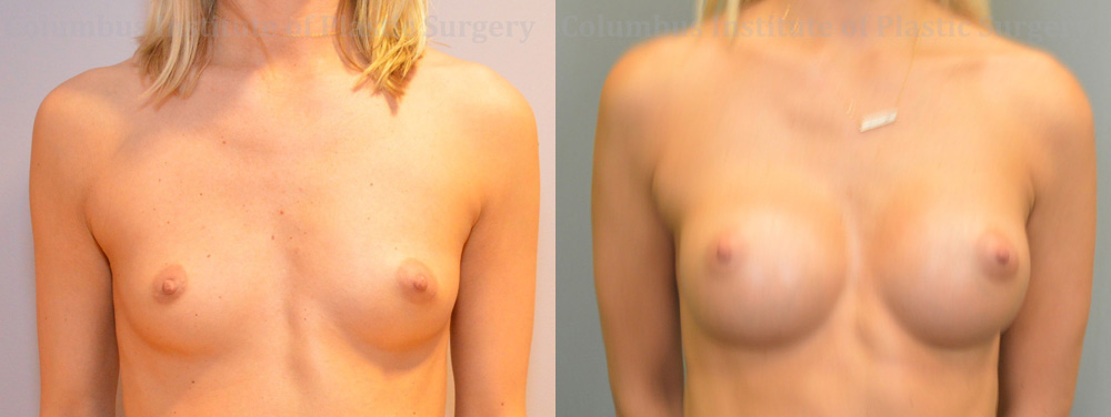Breast Augmentation – 300cc-400cc before and after photo by Columbus Institute of Plastic Surgery in Columbus, OH