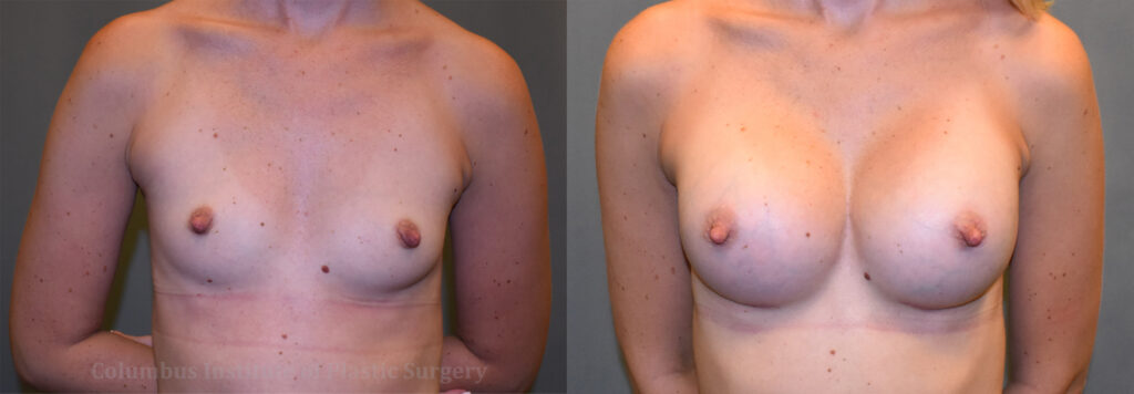 Breast Augmentation – 400cc-500cc before and after photo by Columbus Institute of Plastic Surgery in Columbus, OH