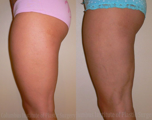 Liposuction before and after photo by Columbus Institute of Plastic Surgery in Columbus, OH