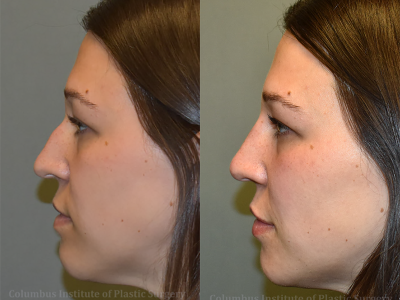 Nonsurgical Rhinoplasty before and after photo by Columbus Institute of Plastic Surgery in Columbus, OH
