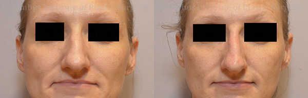 Nonsurgical Rhinoplasty before and after photo by Columbus Institute of Plastic Surgery in Columbus, OH