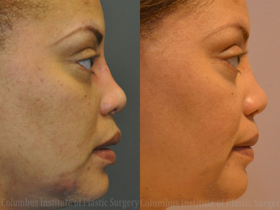 Nonsurgical Rhinoplasty before and after photo by Columbus Institute of Plastic Surgery in Columbus, OH