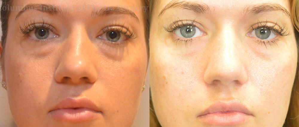Nonsurgical Rhinoplasty before and after photo by Columbus Institute of Plastic Surgery in Columbus, OH