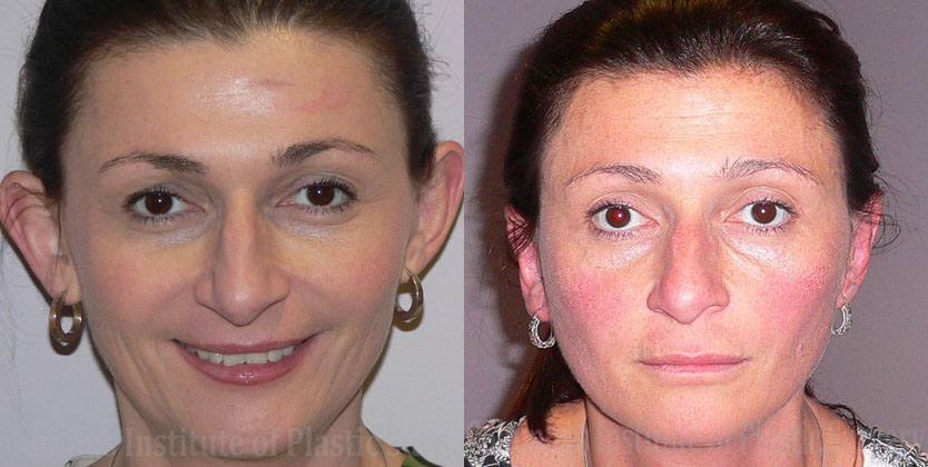 Otoplasty before and after photo by Columbus Institute of Plastic Surgery in Columbus, OH