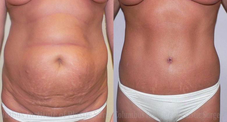 Abdominoplasty (Tummy Tuck) before and after photo by Columbus Institute of Plastic Surgery in Columbus, OH
