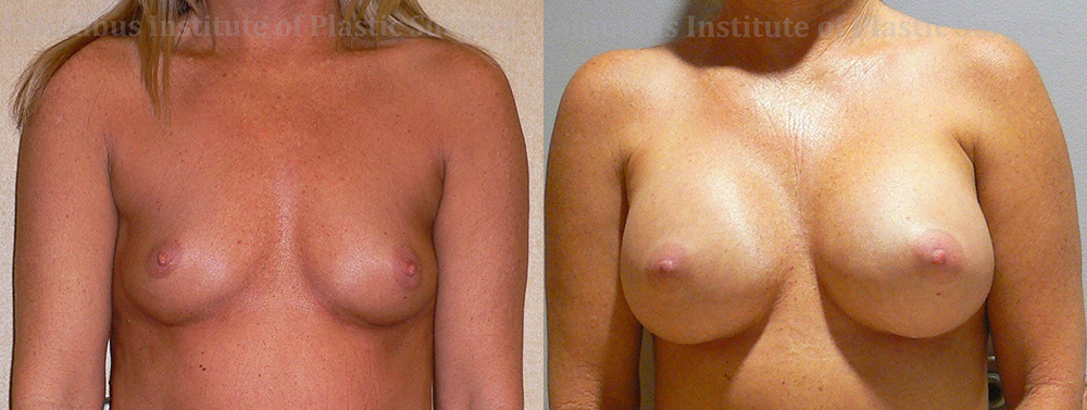 Breast Augmentation – 300cc-400cc before and after photo by Columbus Institute of Plastic Surgery in Columbus, OH