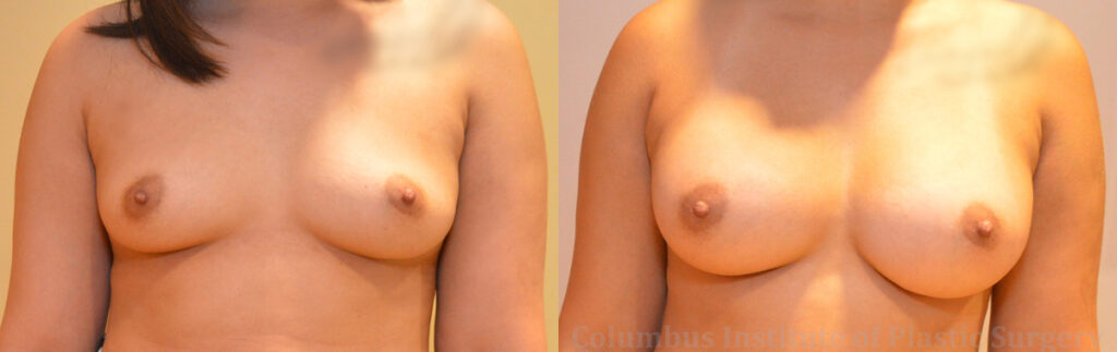 Breast Augmentation – 400cc-500cc before and after photo by Columbus Institute of Plastic Surgery in Columbus, OH