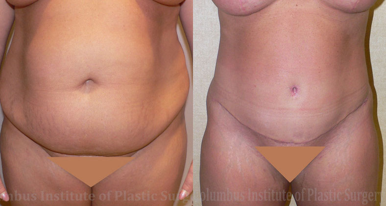 Abdominoplasty (Tummy Tuck) before and after photo by Columbus Institute of Plastic Surgery in Columbus, OH
