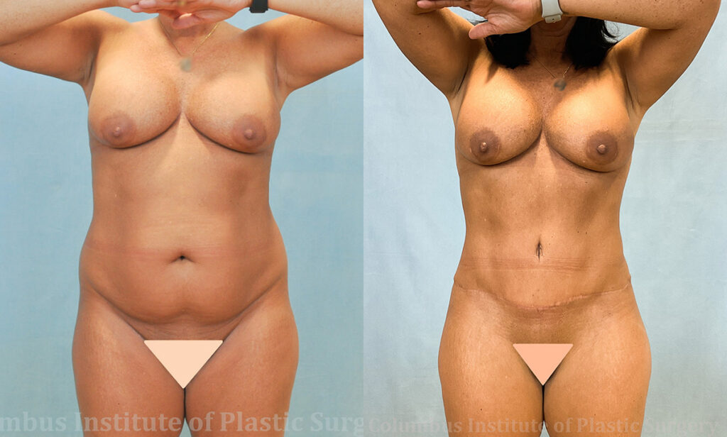 Abdominoplasty (Tummy Tuck) before and after photo by Columbus Institute of Plastic Surgery in Columbus, OH