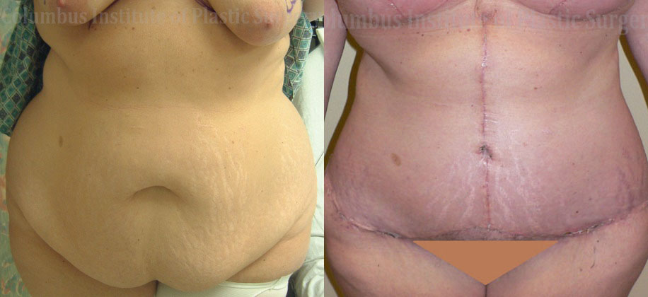 Belt Lipectomy before and after photo by Columbus Institute of Plastic Surgery in Columbus, OH