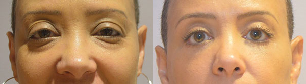 Blepharoplasty before and after photo by Columbus Institute of Plastic Surgery in Columbus, OH