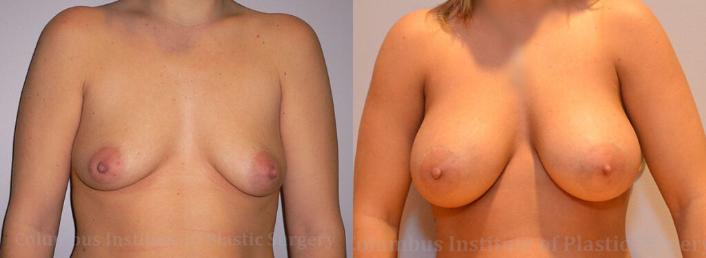 Breast Augmentation – 300cc-400cc before and after photo by Columbus Institute of Plastic Surgery in Columbus, OH