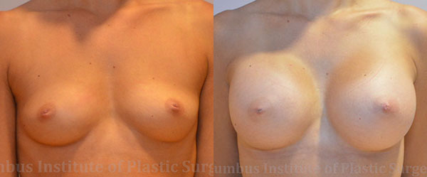 Breast Augmentation – 400cc-500cc before and after photo by Columbus Institute of Plastic Surgery in Columbus, OH