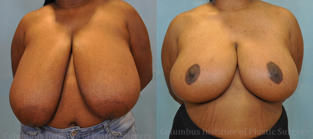 Breast Reduction before and after photo by Columbus Institute of Plastic Surgery in Columbus, OH