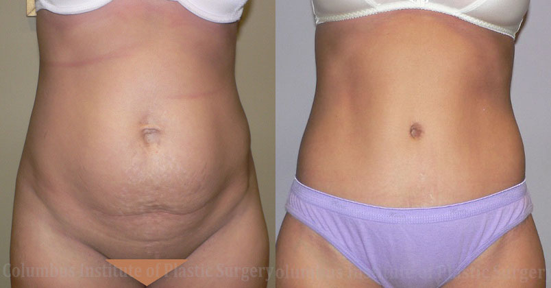 Abdominoplasty (Tummy Tuck) before and after photo by Columbus Institute of Plastic Surgery in Columbus, OH