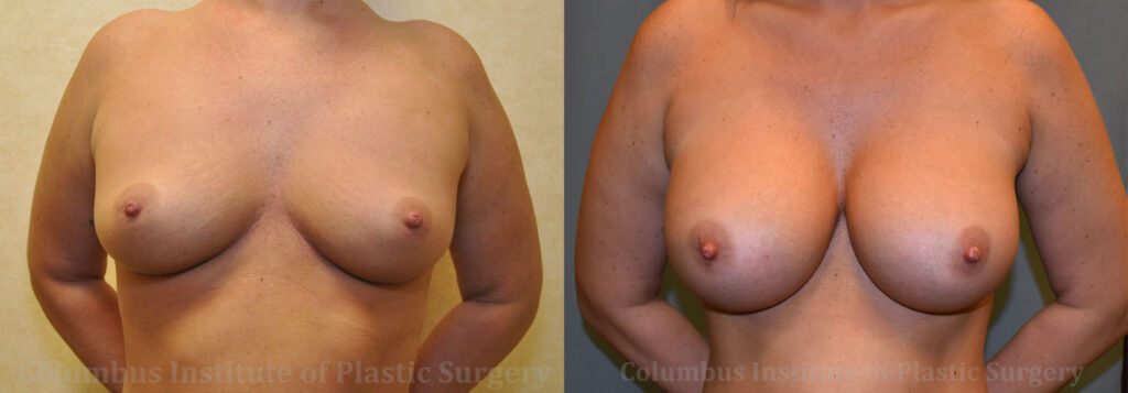 Breast Augmentation – 400cc-500cc before and after photo by Columbus Institute of Plastic Surgery in Columbus, OH
