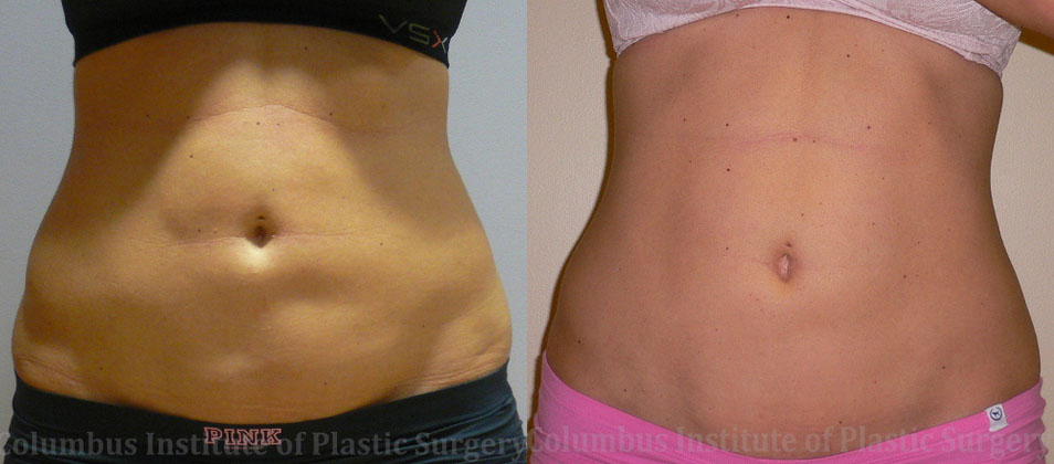 Liposuction before and after photo by Columbus Institute of Plastic Surgery in Columbus, OH