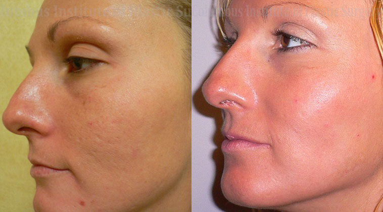 Phenol Chemical Peel before and after photo by Columbus Institute of Plastic Surgery in Columbus, OH